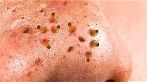 Extreme blackhead popping on nose - Before, during & after the pimple popping process on a #Showoff's nose. Sometimes, a pimple cannot heal underneath the skin on its own. But only pop a pimple...